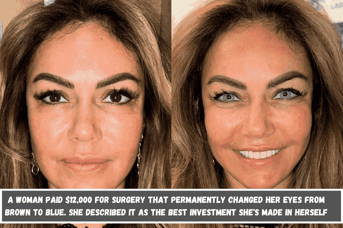 A woman paid $12,000 for surgery that permanently changed her eyes from brown to blue. She described it as the best investment she's made in herself